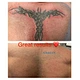Piccoscond Laser Pico Lase Q Switched Nd Ydg 755nm 1064 Tattoo Removal Machine Picolaser Tattoo Remo